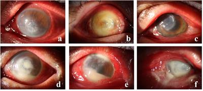 Spectrum and antibiotic sensitivity of bacterial keratitis: a retrospective analysis of eight years in a Tertiary Referral Hospital in Southwest China